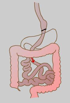 Laparoscopic Gastric Bypass