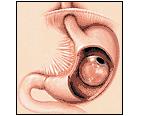 Intragastric Balloon