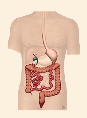 Lap Biliopancreatic Diversion