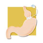 Laparoscopic Gastric Banding